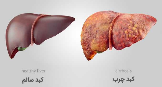 کبد چرب (یا چربی در کبد) یک وضعیت پزشکی است که در آن مقدار غیرعادیی از چربی در کبد تجمع می‌یابد. این وضعیت به دلیل انباشت چربی در سلول‌های کبدی به نام هپاتوسیت‌ها رخ می‌دهد. دو نوع اصلی از کبد چرب وجود دارد:   1. کبد چرب غیرالکلی (Non-Alcoholic Fatty Liver Disease - NAFLD): در این نوع کبد چرب، چربی  ...