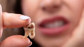 پوسیدگی دندان یک مشکل دندانی است که به طور عام به ازدیاد باکتری‌های دهانی و تجمع ترکیبات اسیدی روی دندانها و دیگر عوامل مرتبط با تغذیه و بهداشت دهانی برمی‌گردد. این فرآیند می‌تواند به تخریب تدریجی ساختار دندانها منجر شود.   پوسیدگی دندان معمولاً با علائمی مانند درد دندان، حساسیت به طعام و نوشیدنی‌ها ...
